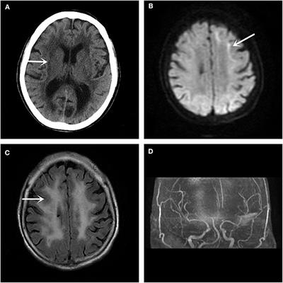 Frontiers | Alice in Wonderland Syndrome as a Presenting